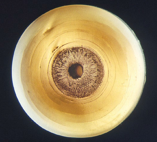 Here is a cross-section through a drilled natural pearl (approx. 5 mm diameter.) The inner part is rich in organic material made of calcite prisms. The outer part shows fine concentric rings and is made of nacre. Photo courtesy of H.A. Hänni, SSEF and GemExpert, via missjoaquim.com